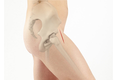 Anterior approach hip replacement