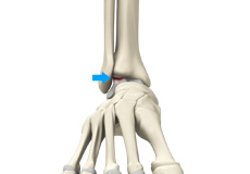 Osteochondral Lesions of the Ankle