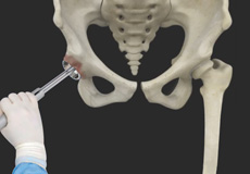 Robotic Total Hip Replacement